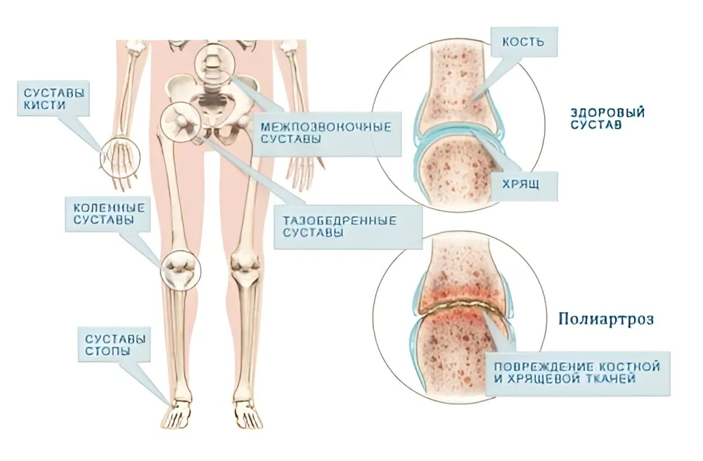 Что такое полиартроз суставов?