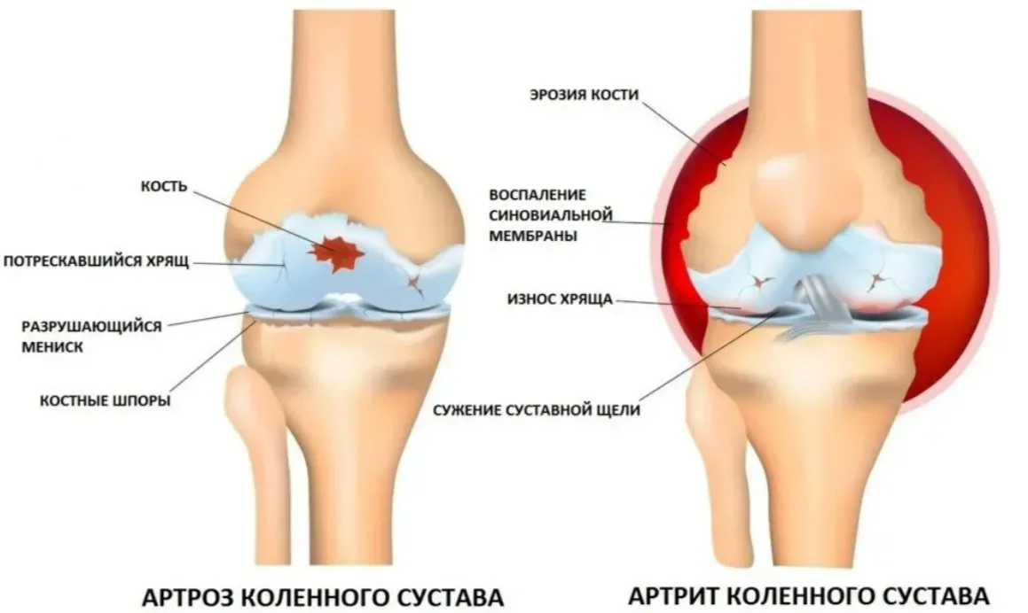 Артрит и артроз в чем разница?