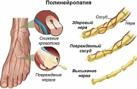 Полинейропатия - что это такое?