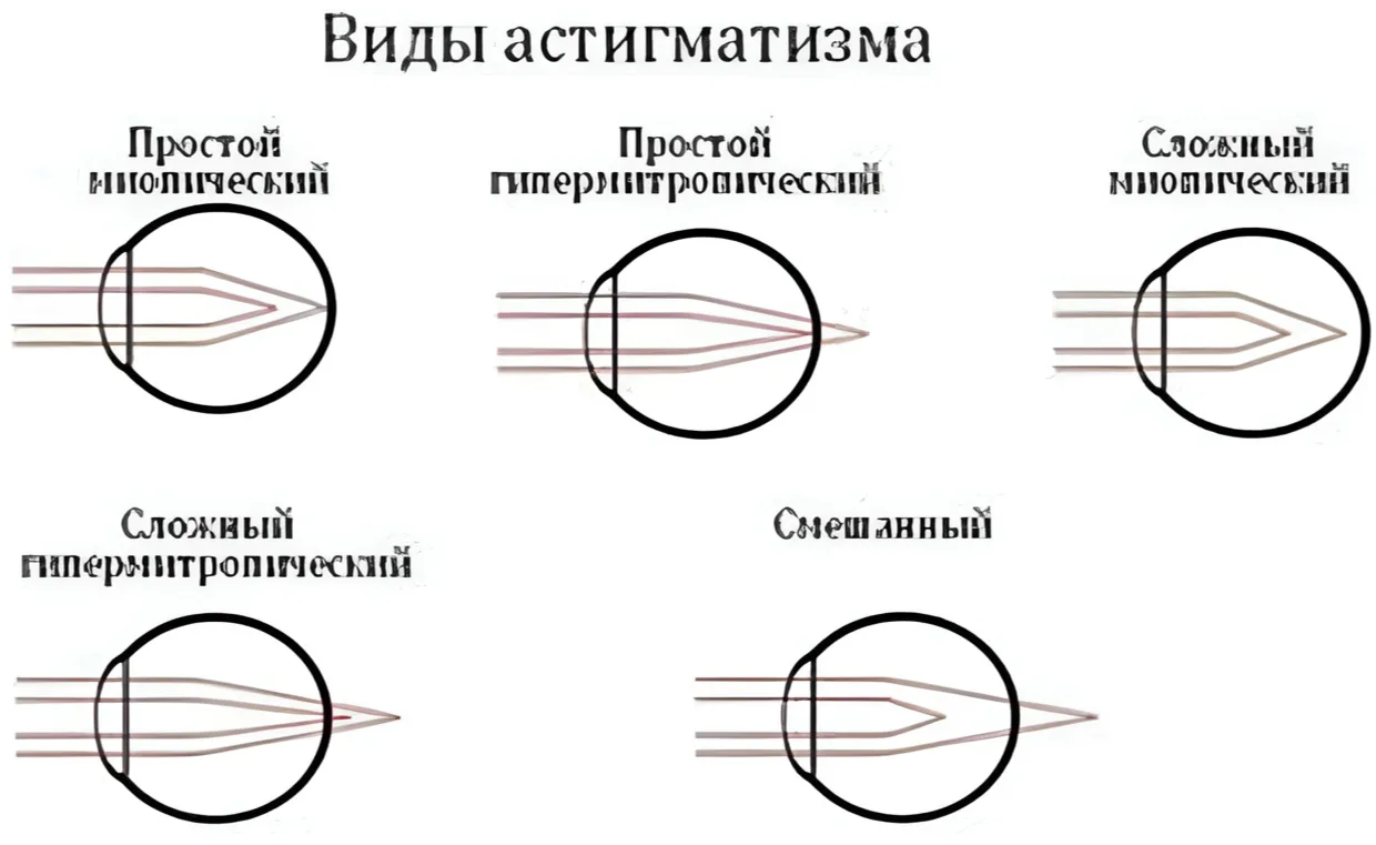 Что такое астигматизм?