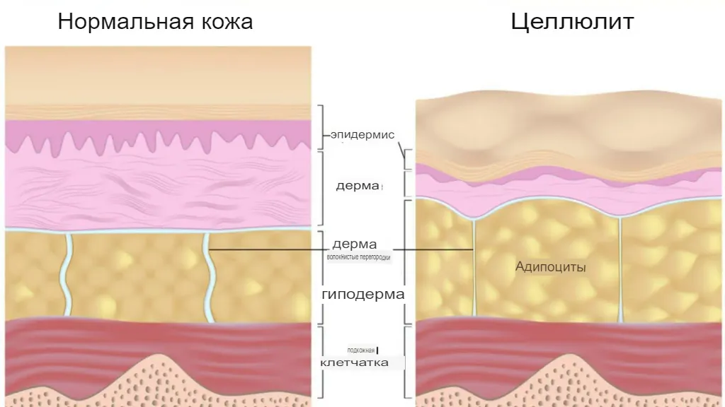 Что такое целлюлит?