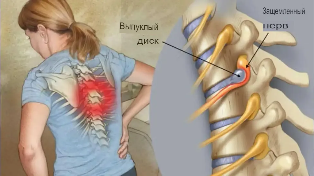 Что такое корешковый синдром (радикулопатия)?