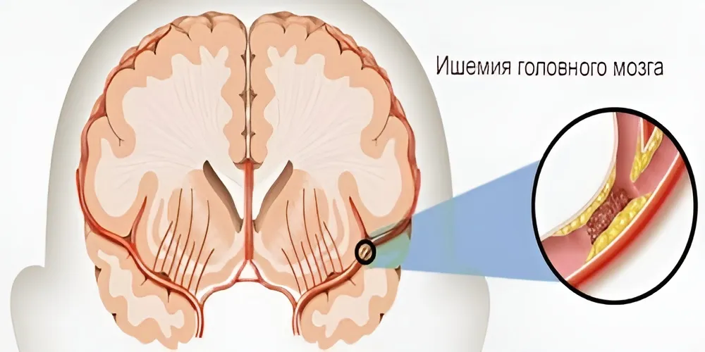 Ишемия головного мозга - что это такое?