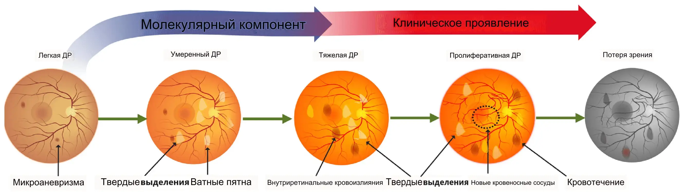 Диабетическая ретинопатия