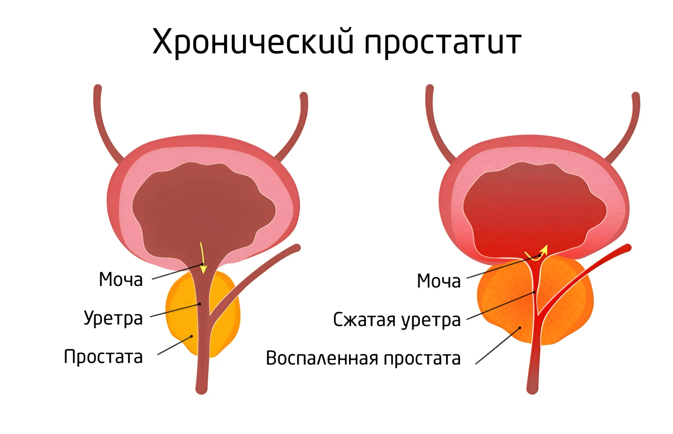 Как лечить хронический простатит?