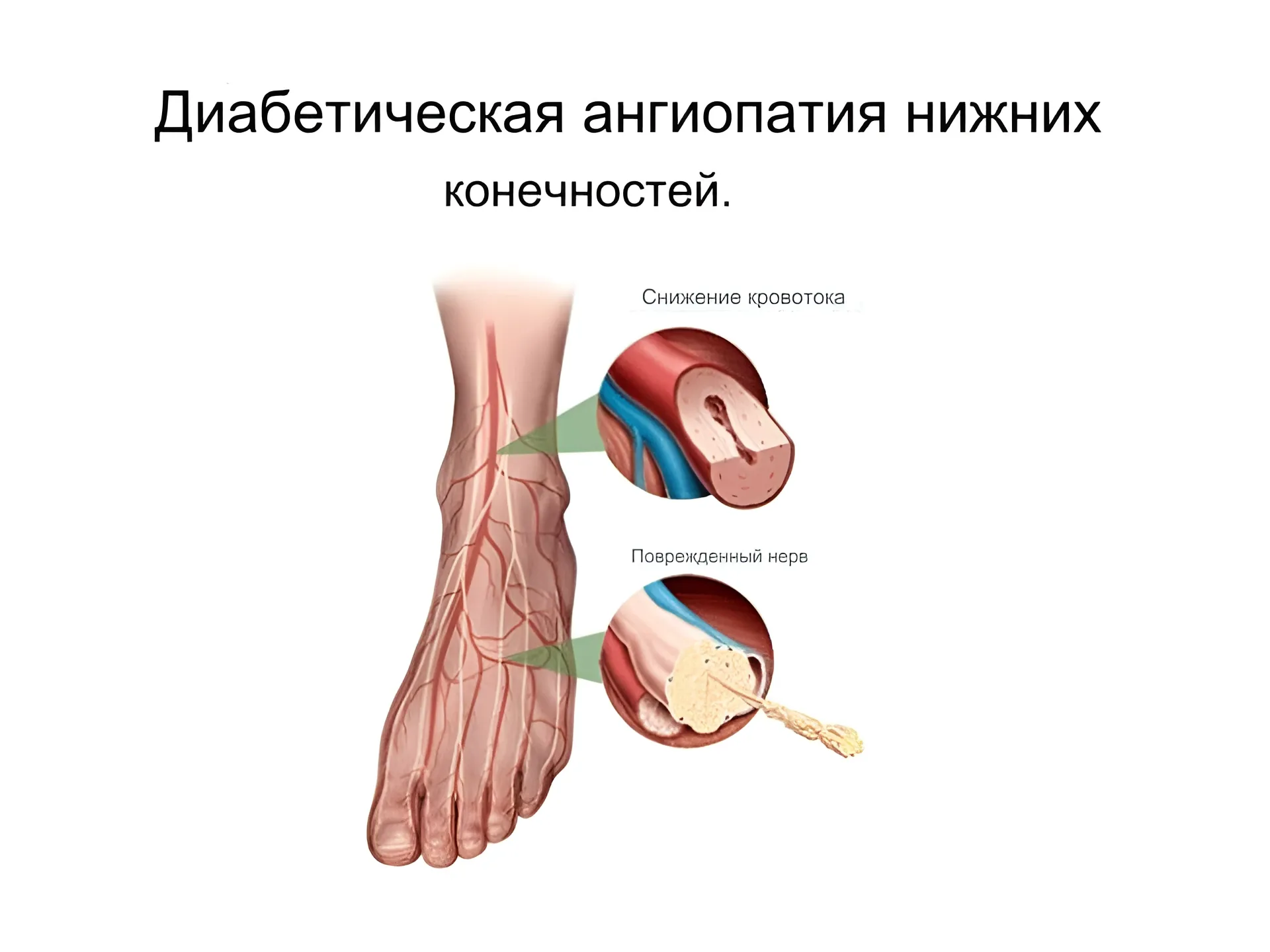 Диабетическая ангиопатия