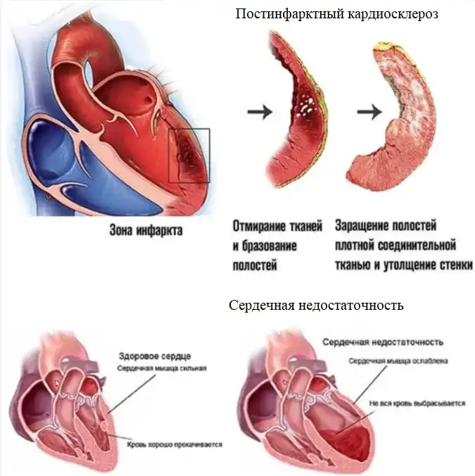 Ишемическая болезнь сердца - что это такое?