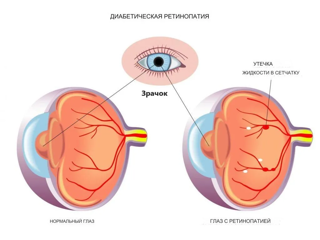 Диабетическая ретинопатия