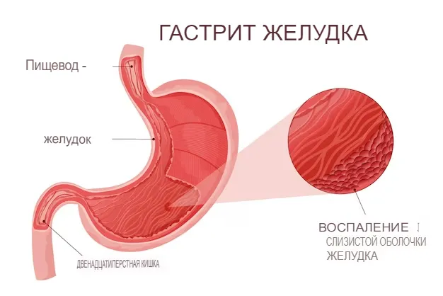 Что такое гастрит?