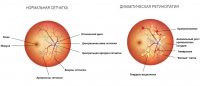 Діабетична ретинопатія
