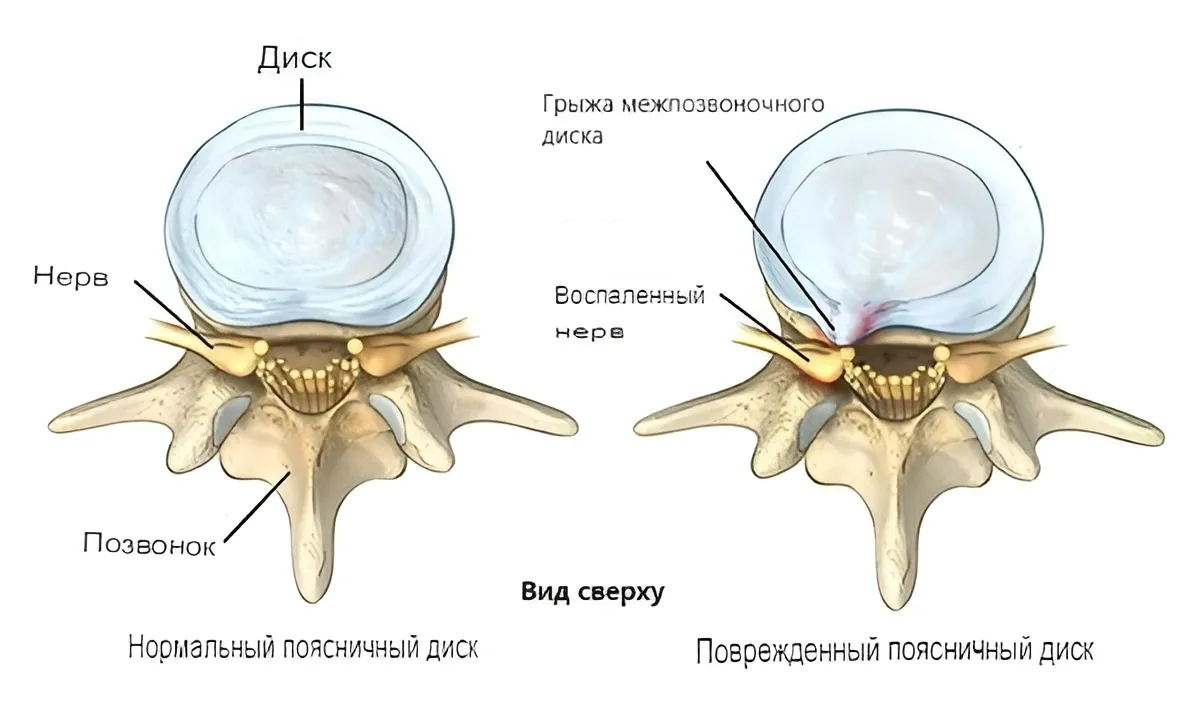 Позвоночная грыжа