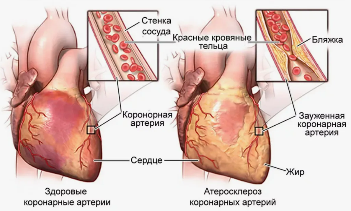 Что такое стенокардия сердца?