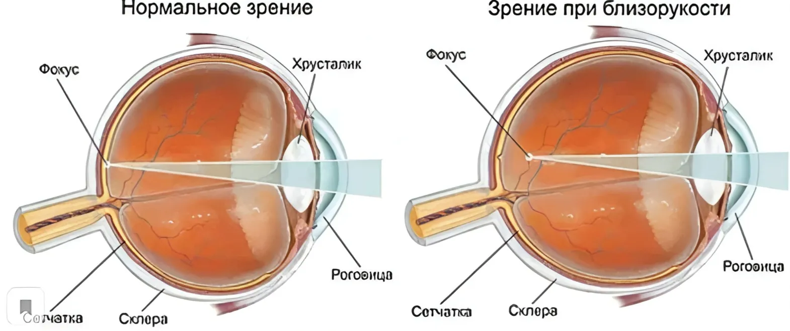 Что это такое миопия глаза?