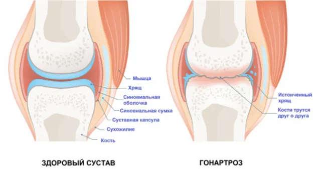 Что такое гонартроз коленного сустава?