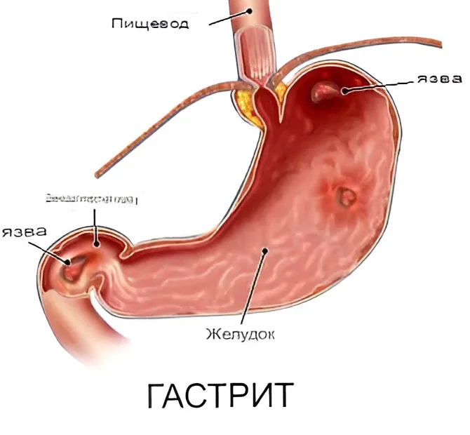 Что такое гастрит?