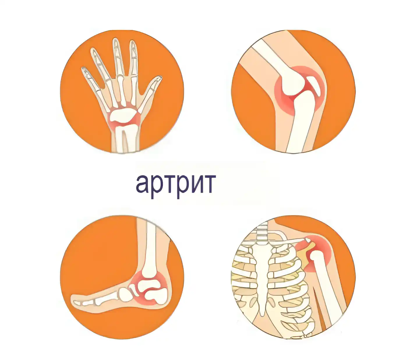 Что такое артрит?