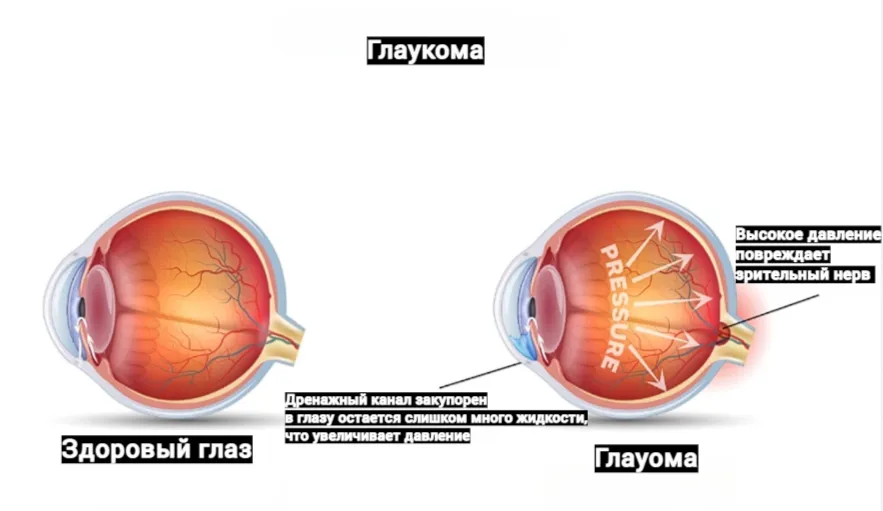 Глаукома - что это за болезнь?