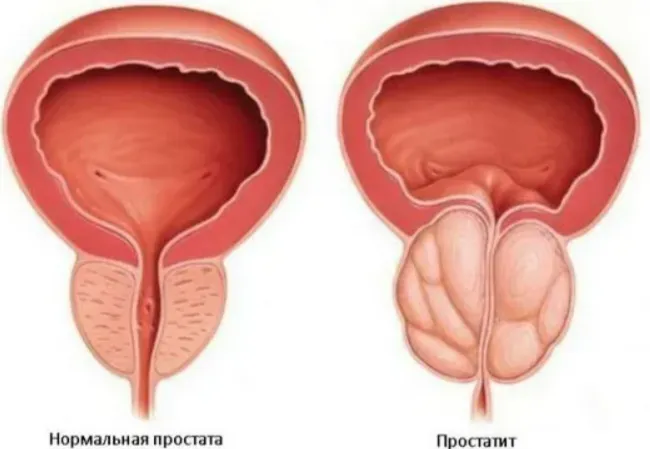 Как лечить простату?