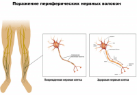 Полінейропатія - що це таке?