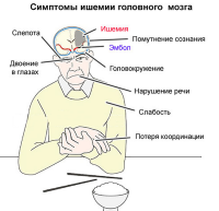 Ишемия головного мозга - что это такое?