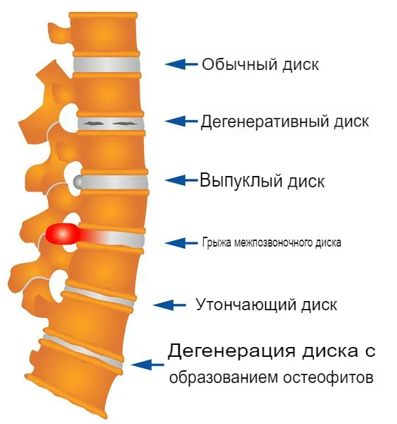 Позвоночная грыжа