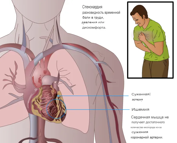 Что такое стенокардия сердца?