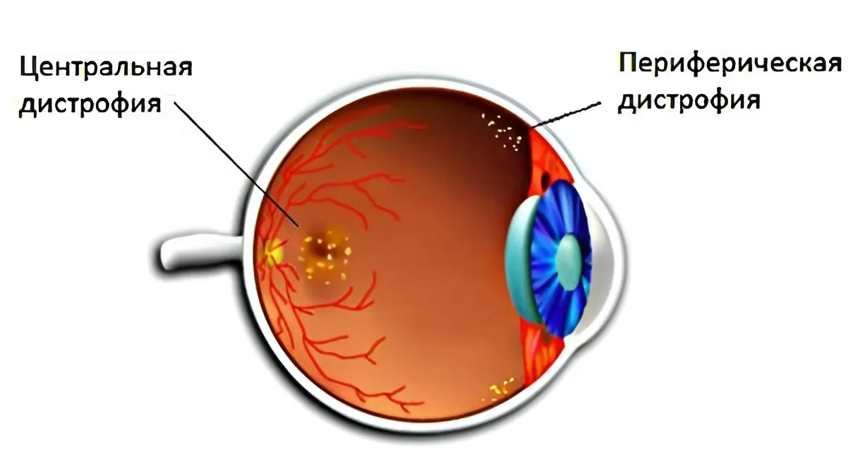Дистрофия сетчатки