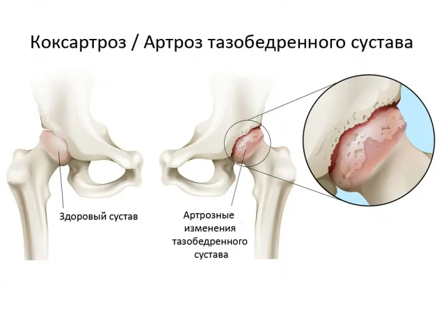 Коксартроз тазобедренного сустава - диагностика и лечение.