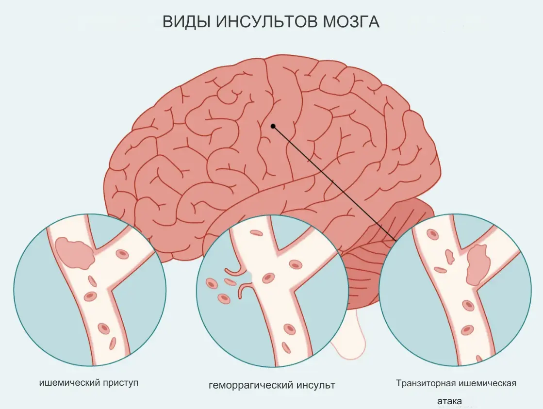 Инсульт