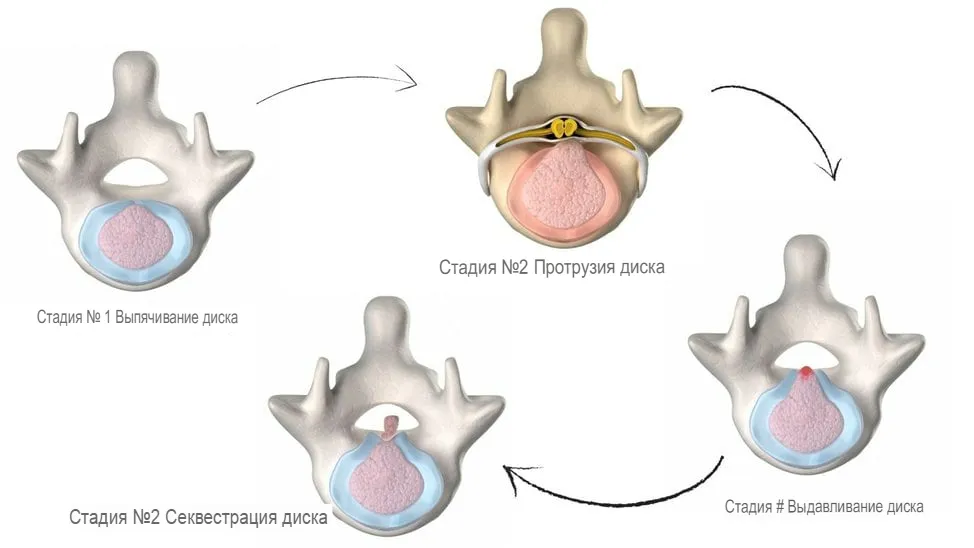 Позвоночная грыжа