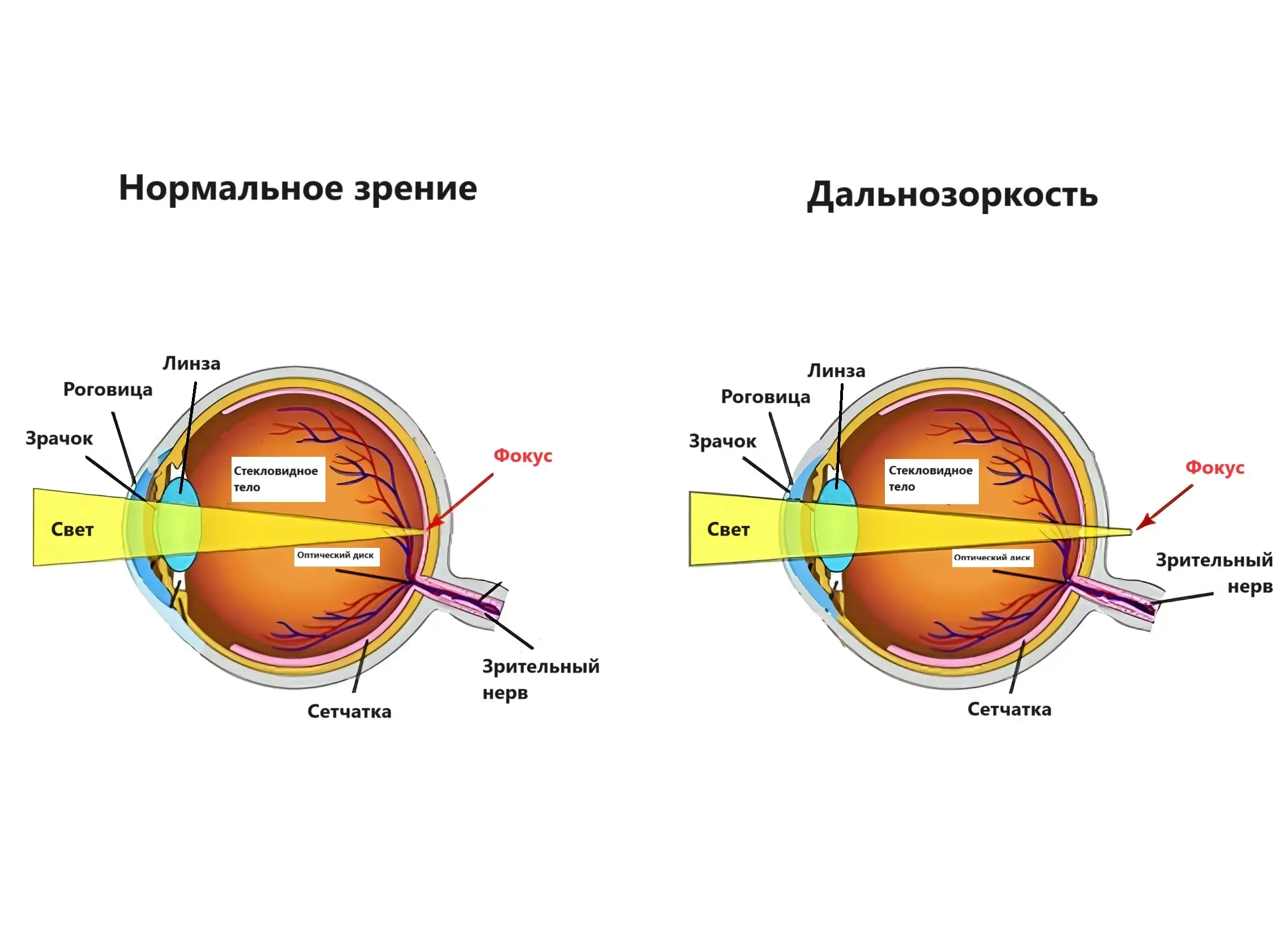 Дальнозоркость