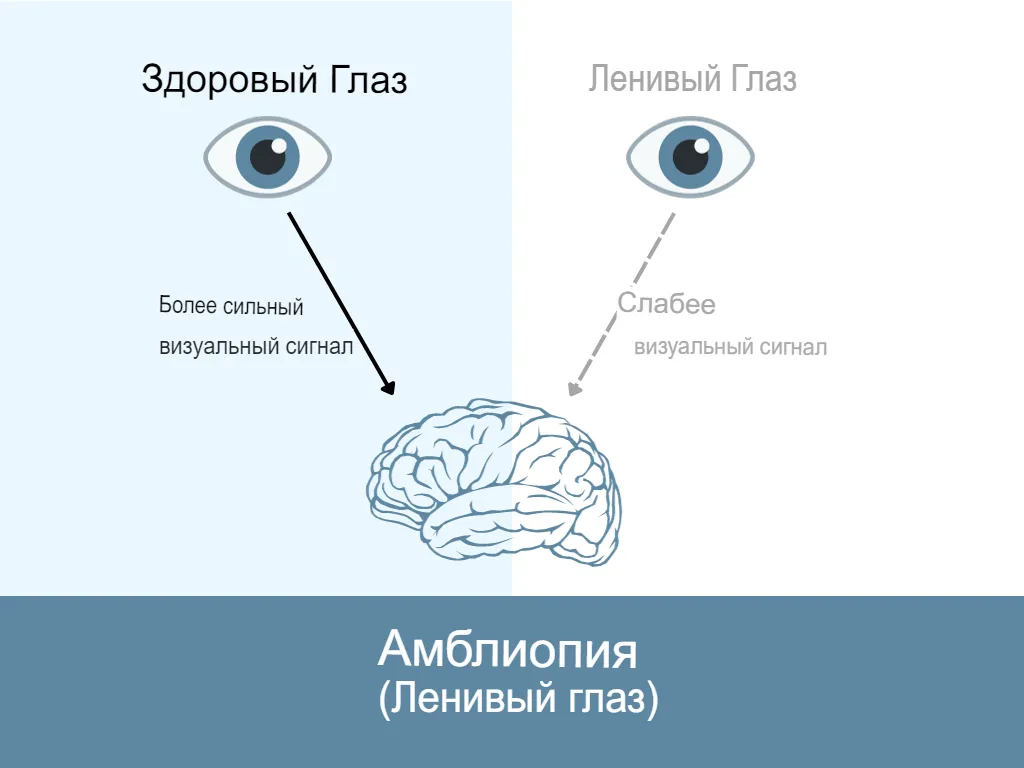 Амблиопия