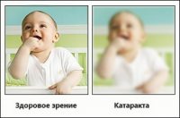 Что такое катаракта глаза?