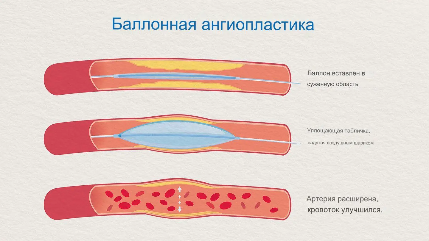 Инфаркт миокарда